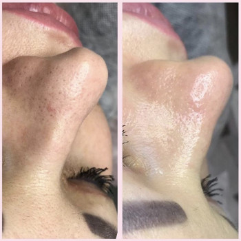 Пилинг prxT-33
                    Косметолог Анна Гетьман Харків