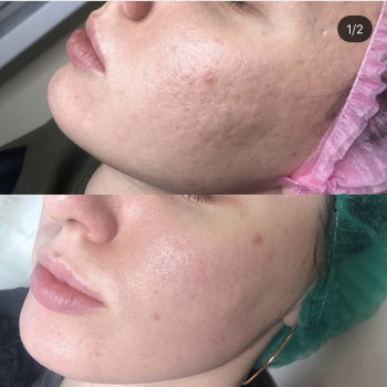 Пилинг prxT-33
                    Косметолог Анна Гетьман Харків