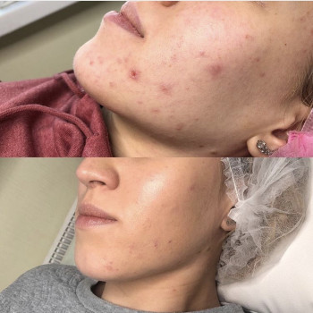 Пилинг prxT-33
                    Косметолог Анна Гетьман Харків