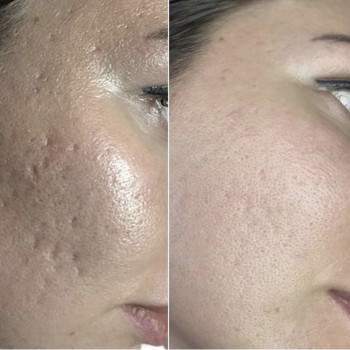 Лечение анке
                    Косметолог Анна Гетьман Харків