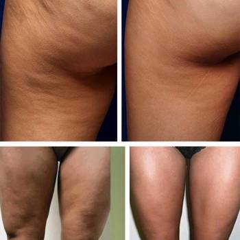 Результат EndoSpheres Therapy