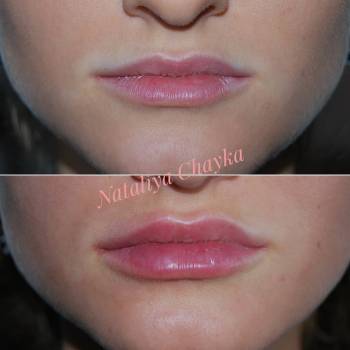 Контурна пластика губ
 