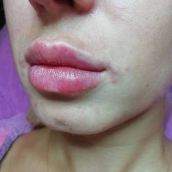 Сразу после процедуры увеличения губ