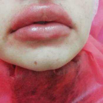 Сразу после процедуры увеличения губ