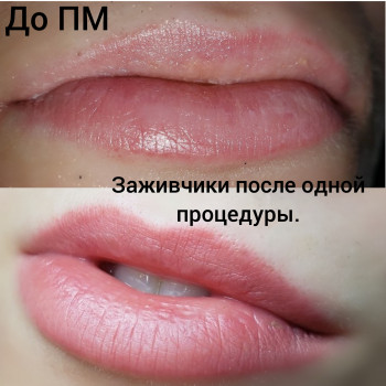 ДО и Зажившие губки