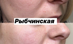 PDRN полінуклеотиди Лікар-косметолог Наталия Київ