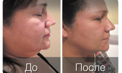 Триада ферментів PB Serum (корекція нижньої третини обличчя, моделювання овалу) Косметолог Анна Винница