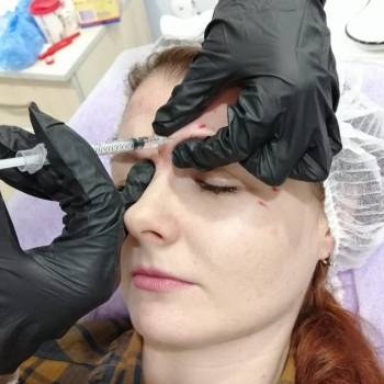 Ботулинотерапия