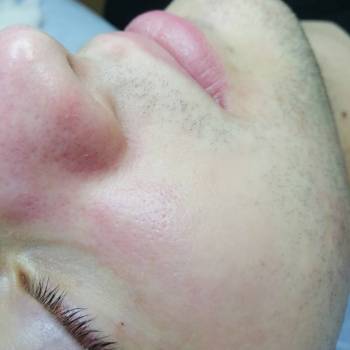 Чистка лица