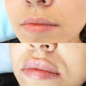 Аугментації губ 1ml.