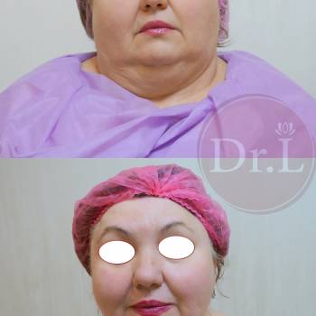 Липолиз второго подбородка