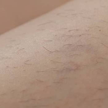 Шкіра до процедури депіляції