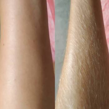 До та після депіляції