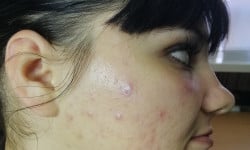 Мезотерапия при акне , постакне и расширенных порах Косметолог Анна Вінниця