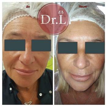 Работа с носогубными складками