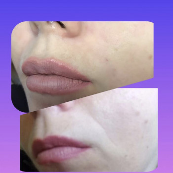 Заповнення носогубних складок
                    Косметолог-инъекционист Марина Днепр