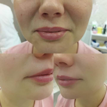 Заповнення носогубних складок
                    Косметолог-инъекционист Марина Днепр