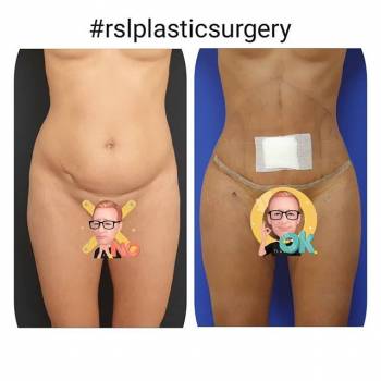 Липомоделирование живота бёдер и ягодиц.