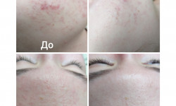 Лечение акне Косметолог-естетист Светлана Полтава