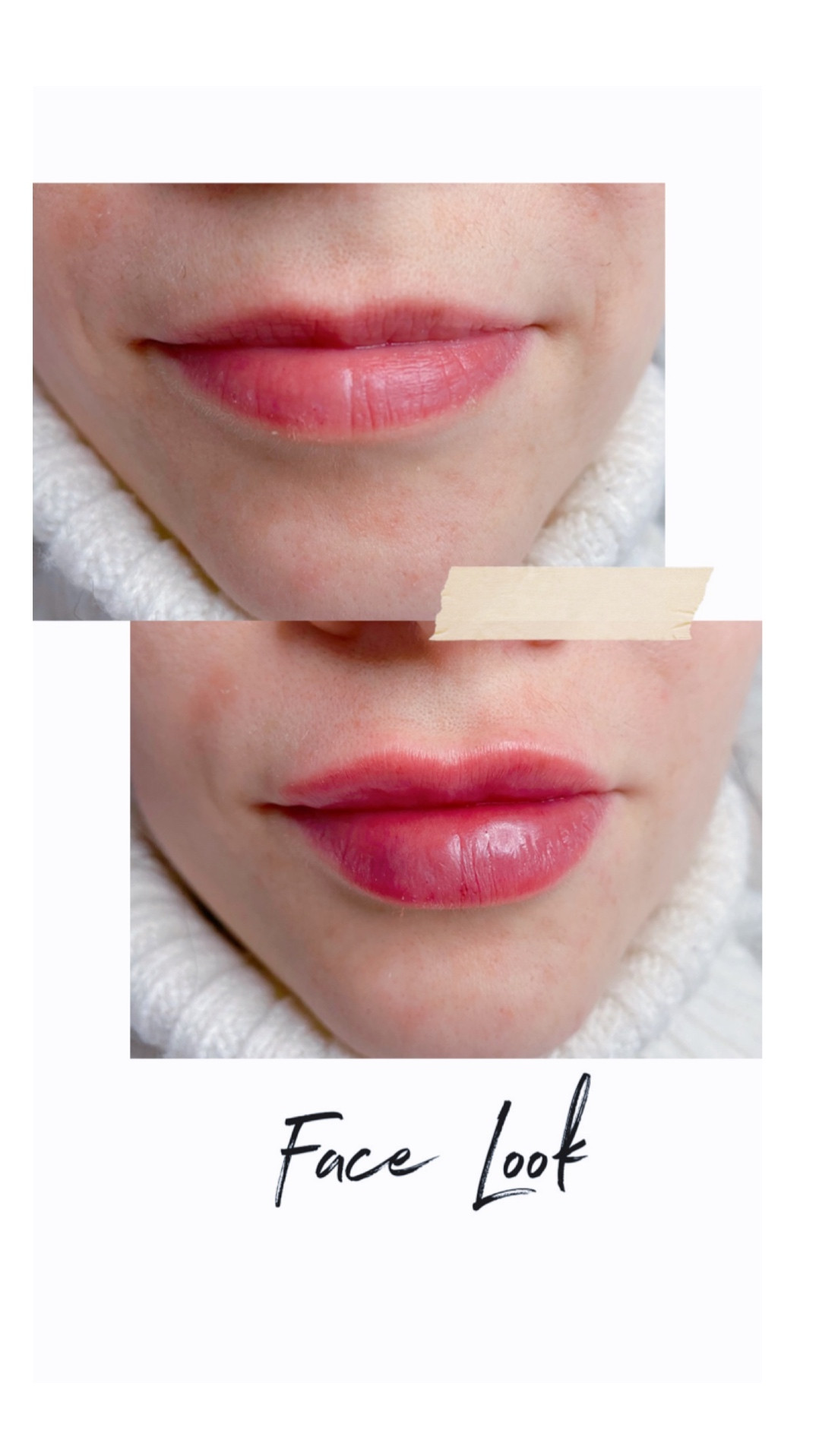 Увеличение губ контурная пластика аугментация, фото - Студия татуажа Face Look