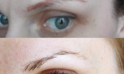 Лазерное удаление татуажа ND Yag Q-switched Студія татуажу Lmakeup Studio Київ
