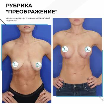 підтяжка грудей