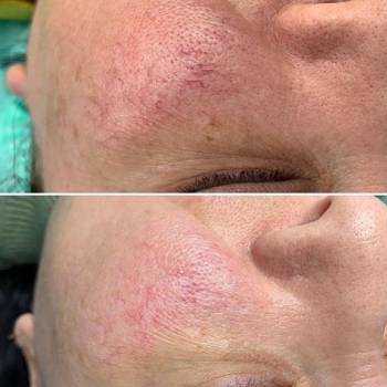 убираем сосудистые цвездочки