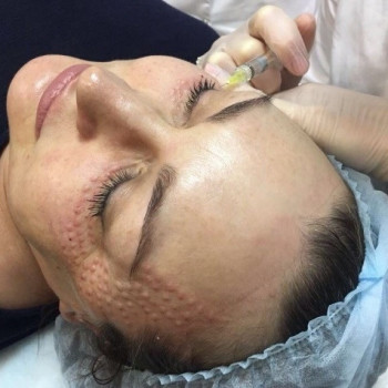 Мезотерапия
                    Косметологический центр Надия Кривой Рог