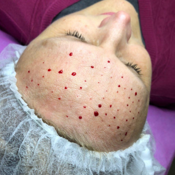 Мезотерапия
                    Косметологический центр Надия Кривой Рог