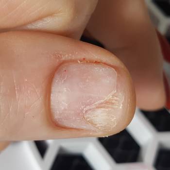 Зачистка механического онихолизиса