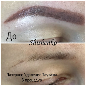 Лазерное Удаление некачественного татуажа
                    Салон краси Studio Shishenko Дніпро