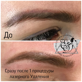 Лазерное Удаление некачественного татуажа
                    Салон краси Studio Shishenko Дніпро