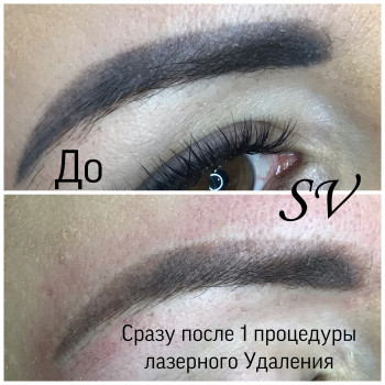 Лазерное Удаление некачественного татуажа
                    Салон краси Studio Shishenko Дніпро