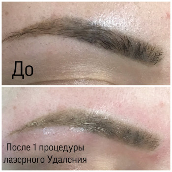 Лазерное Удаление некачественного татуажа
                    Салон краси Studio Shishenko Дніпро