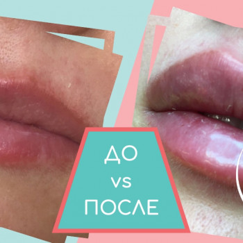 Контурная пластика губ