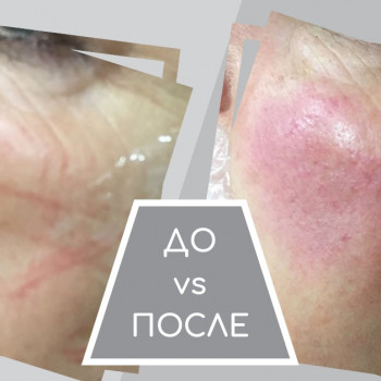 Контурная пластика лица
                    Косметолог Элла Запорожье