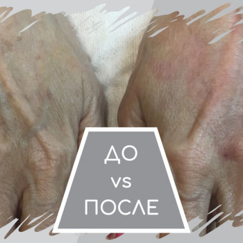 Контурная пластика лица
                    Косметолог Элла Запорожье