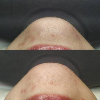 Электроэпиляция волос на подбородке, над верхней губой