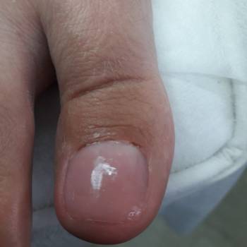 Временное протезирование ногтевой пластины гелем с клотримаз