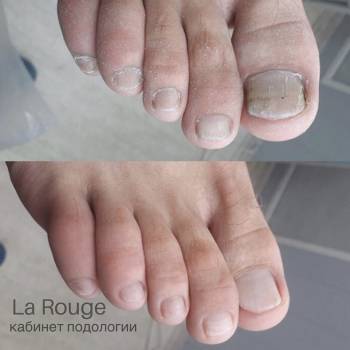 Аппаратная обработка ногтевой пластины