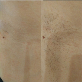 Шугаринг подмышки