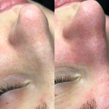 Чистка обличчя
                    Лікар-косметолог Катерина Івано-Франківськ