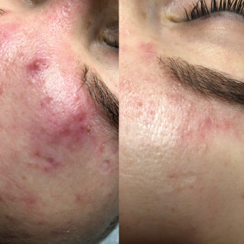 Чистка обличчя
                    Лікар-косметолог Катерина Івано-Франківськ