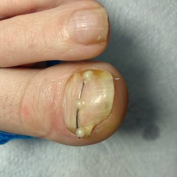 Установка корректирующей системы Титановая нить