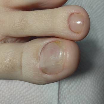 Протезирование ногтевой пластины