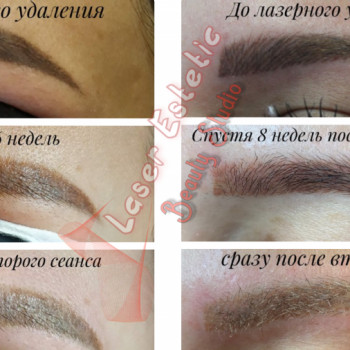 Лазерное удаление татуажа губ и бровей
                    Косметолог Юлия Харків