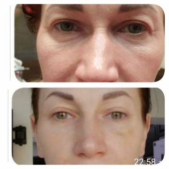 Полимолочная кислота. На 10 лет моложе . Результат огонь!!