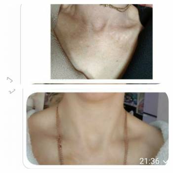 Полимолочная кислота 