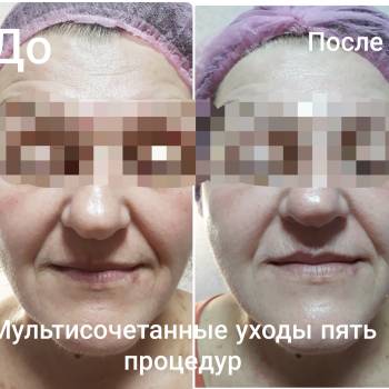 Микротоки
Неинвазивная мезотерапия