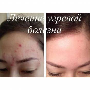 догляд за обличчям, корекціяз моршок, косметологія обличчя
